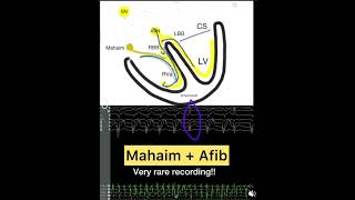 Mahaim fiber tachycardia [upl. by Sama]