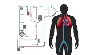 Editors Choice Modified Thermodilution in Extracorporeal Therapy [upl. by Kunz]