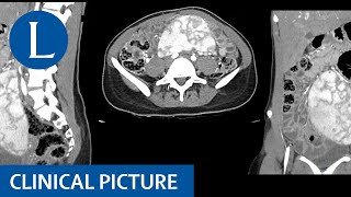 A wandering spleen splenomegaly hypersplenism and iron deficiency anaemia [upl. by Diarmuid]