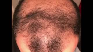 6 months using minoxidil  Rogaine 5 Before amp After results [upl. by Ecertal790]