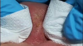 ENJOY YOUR DAY WITH JOSEFA REINA relaxing blackheads [upl. by Gelya]