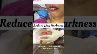 Dark Lip Correction with Laser Lip lightening treatment is a safe method that can lighten the tone [upl. by Fonzie]