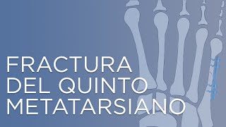 Fractura del quinto metatarsiano  IQTRA [upl. by Rodablas]