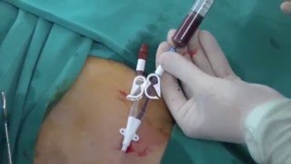 Permanent HD Cath insertion [upl. by Keyser421]