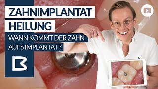 ZAHNimplantat  Heilung Wann kommt der ZAHN auf das Implantat Genaue Zeitangaben [upl. by Goldia]