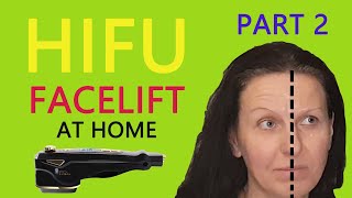 HIFU Face Lift at Home  PART 2 demonstration and review [upl. by Urial]