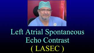 Left Atrial Spontaneous Echo Contrast  L A S E C  In Severe Mitral Stenosis amp Atrial Fibrillation [upl. by Annitsirhc]