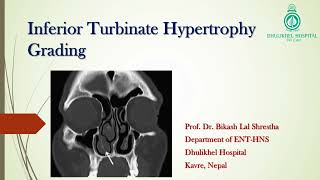 Inferior turbinate hypertrophy nasal cavity Grading [upl. by Lleroj268]