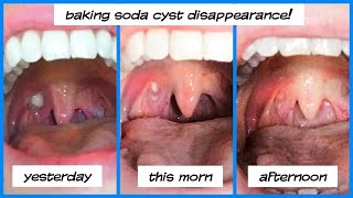 Natural Tonsil Cysts Treatment At Home [upl. by Deadman328]