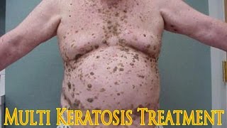 MULTI KERATOSIS Treatment by Liquid Nirtogen Dr Duzhy  Множественные кератомы Лечение [upl. by Olyhs]