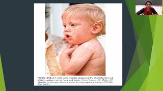 MMR  measles mumps and rubella  full lecture medical [upl. by Ark]