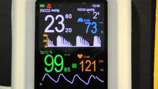 Cardiogenic Oscillations on VM2500M capnograph pulse oximeter [upl. by Elisabet]