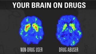 How addiction changes your brain [upl. by Terej]