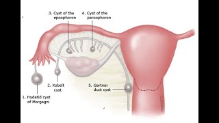 Gynecology 057 Wolffian duct remnant abnormality Gartner duct cyst Hydatid Morgagni Epoophoron [upl. by Yra]