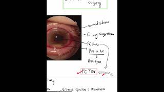 Acute Postoperative Endophthalmitis  Case Discussion In A Minute Mustknow Shorts [upl. by Ondrej]