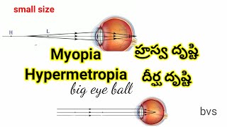 Myopia Hypermetropia corrections [upl. by Havener158]