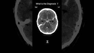 Subarachnoid haemorrhage  CT brain Acute CT Brain Extraaxial hemorrhage 66 radiologychannel007 [upl. by Catie]