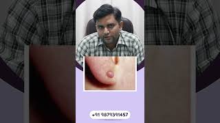 Ear keloid Laser Treatment Keloid Surgery Expert Guidance By Expert Surgeon Best Clinic Surat [upl. by Emilia877]