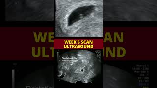 Ultrasound scan week 5  pregnancy scan [upl. by Gui]