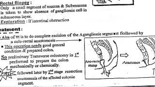 hirschsprung disease  aganglionic megacolon IO P6 [upl. by Souza]