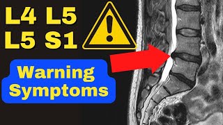 WARNING These Are The 3 MAJOR Symptoms of a Severe L4 L5 L5 S1 Disc Bulge  Dr Walter Salubro [upl. by Veedis908]