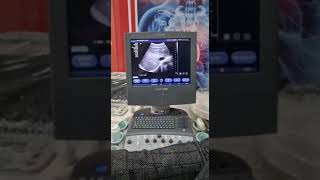 Siemens Acuson x300 Color Doplor gyne obs ultrasound [upl. by Kassity]