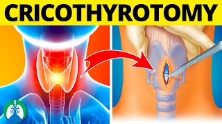 Cricothyrotomy Medical Definition  Quick Explainer Video [upl. by Tybalt]