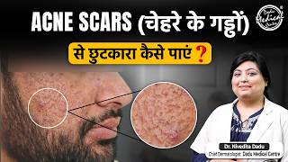 How to Treat Acne Scars  Acne Scar Treatments Laser MNRF PRP  Patients Journey at DMC [upl. by Anissej43]