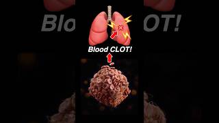 Doctor Explains PULMONARY EMBOLISM 🫁💥 [upl. by Dalury500]