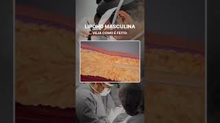 Como é feita a Cirurgia Lipo HD Masculina [upl. by Rowan]