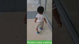 Rickets baby walking [upl. by Rossie979]