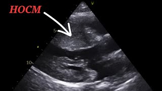 Echo of Restrictive Vs Hypertrophic Vs Dilated Cardiomyopathy [upl. by Annoif]