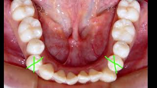 ORTODONCIA MALOCLUSION CLASE I HPO ODONTOLOGÍA ESTÉTICA [upl. by Ahsatniuq]