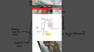 Peripheral Inserted Central Catheter PICC neetpg inicet [upl. by Rebmit]