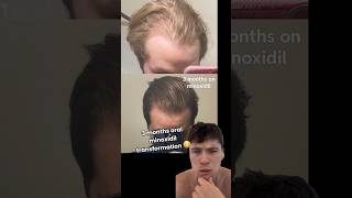 REDDIT HAIR LOSS TRANSFORMATION hairloss minoxidil [upl. by Mcdougall]