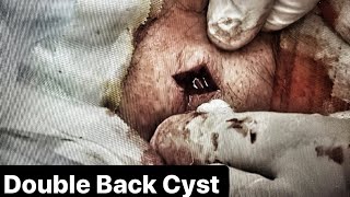 Double Back Cyst Epidermoid Cyst Removal Dr John Gilmore [upl. by Zindman20]