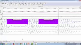 Natus PSG Webinar Case Study Scoring Respiratory Events [upl. by Milty]