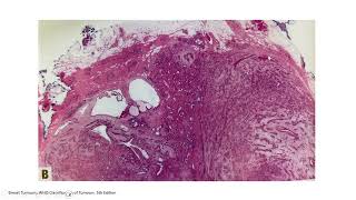 BREASTPATH 20240719 Breast fibroepithelial lesions fibroadenoma phyllodes tumor hamartoma [upl. by Leeth]