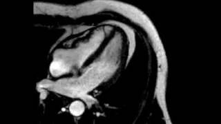 Constrictive pericarditis fourchamber ECGgated cine SSFP MR [upl. by Mond]