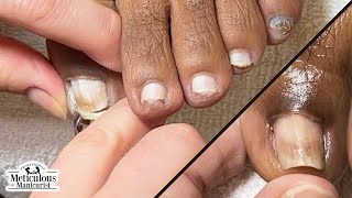 How to Fix Ingrown Toenails at Home nails satisfying [upl. by Ynoep69]