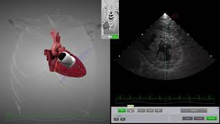 HeartWorks Hypovolemia with Doppler [upl. by Ayatnwahs]