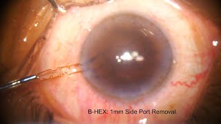 BHEX Pupil Expander Removal Main amp Sideport Incision and under Irrigation [upl. by Abelard]