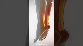 Difference between ligaments and tendons [upl. by Peursem844]