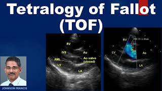 Tetralogy of Fallot TOF [upl. by Peterec]