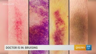 Why bruising matters and what the purple blue and yellow marks can indicate [upl. by Lynde]