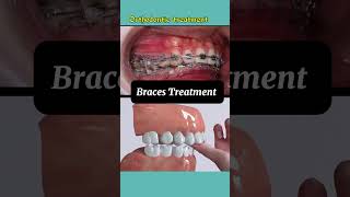 Braces Results braces bracesoff [upl. by Judi95]