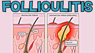 What is Folliculitis Folliculitis EXPLAINED in 2 Minutes  Signs Symptoms Cause Treatment [upl. by Celestine24]