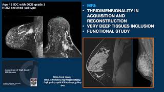 COMPARISON BETWEEN BMRI MAMMOGRAPHY DBT AND CESM [upl. by Palocz143]