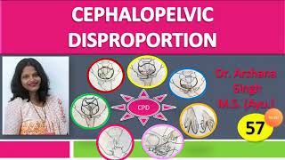 57 Cephalopelvic Disproportion [upl. by Elokin]