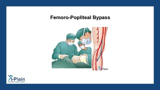 FemoroPopliteal Bypass [upl. by Yasmine]